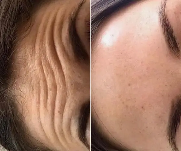 antes-x-depois-12